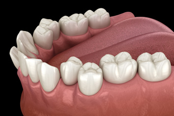 Digital image of crowded teeth 