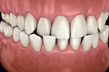 Digital image of a crossbite 