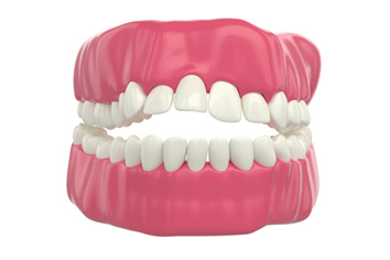 Digital image of an open bite 