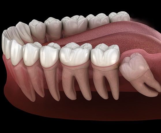 a 3D illustration of impacted wisdom teeth