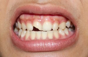 Close-up of smile with chipped front tooth.